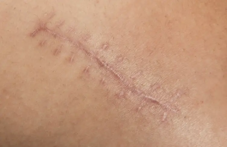 Back pain near left shoulder blade