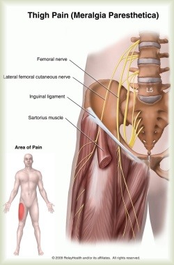 bernhardt paresthesia