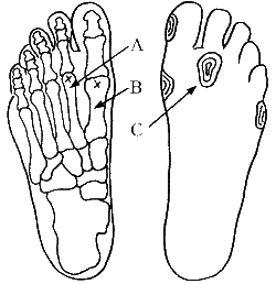 bottom of foot near toes hurts