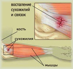 Soreness on outside of elbow