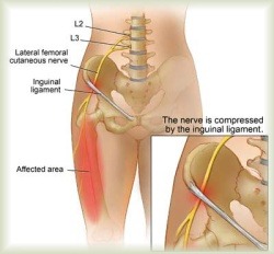 pins and needles in hip area 