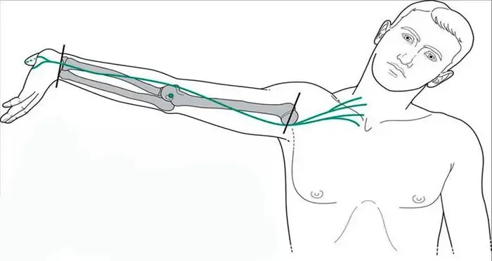 Neurodynamic techniques
